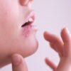 Como saber se você tem herpes?