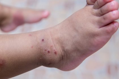 Ouro Preto (MG) vive surto da síndrome ‘mão-pé-boca’ e suspende aulas