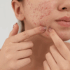 Sinergia para tratar acne através da aromaterapia, veja receita!