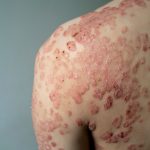 Tratamentos para psoríase: eficácia dos métodos comprovados e mitos desmascarados